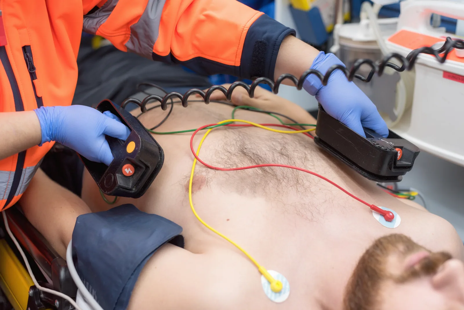 Desfibrilação com pás em paciente em parada cardiorrespiratória